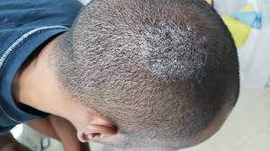 Skin fungus or tinea versicolor. Itchy Flaking White Spots On Scalp Dermatology Forums Patient
