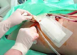 Redon mit und ohne sog. Redon Drainage Behandlung Wirkung Risiken Medlexi De