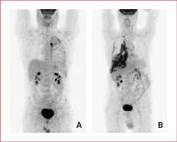 Check spelling or type a new query. Fdg Pet Images Of Two Different Patients With Mesothelioma With Download Scientific Diagram