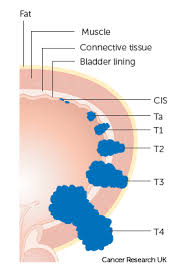 This is typically the first sign of bladder cancer. Stages Bladder Cancer Cancer Research Uk