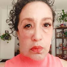 Hi guys! I'm Yamile 🇲🇽. I've been wanting to write for a while but I'm  embarrassed,I saw a post about a girl with a plexiform tumor. I had  something similar but thank