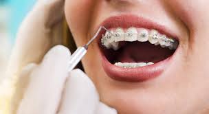 Jul 16, 2021 · what does orthodontic insurance typically include? Orthodontic Care For Adults How To Pay For Braces