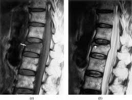 One and a half years back i got a compressed l1 fracture as a result of a car accident. Malignant And Benign Compression Fractures Differentiation And Diagnostic Pitfalls On Mri Sciencedirect