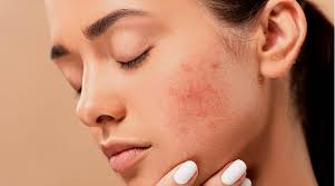 Vitamin e oil also helps regulate the production of collagen, which helps shrink a large blemish. Tired Of Looking At An Ugly Pimple Try This Overnight Paste For Relief Lifestyle News The Indian Express