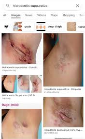 Image result for sore skin in the groin area