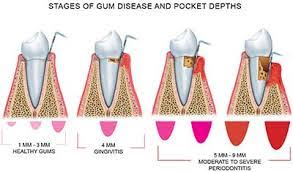 what are periodontal pockets tavern street dental