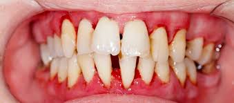 When you have braces, it may seem like nothing is more difficult than keeping them properly clean. 7 Common Bite Problems How Braces Can Fix Them