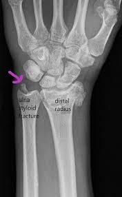 An injury or tear to the tfcc can cause chronic wrist pain. Tfcc Injury Geelong Hand Therapy