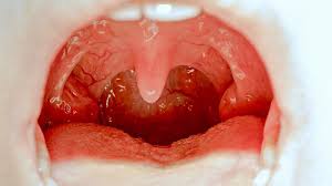 See full list on apotheken.de á… Mandelentzundung Ursachen Symptome Und Behandlung