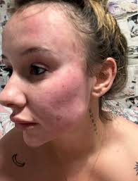 Hi I'm in desperate need of advice as I can't seem to get anything from the  medical profession. I've had acid reflux for about 20 years now and taking  meds. About 3