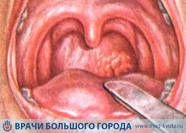 Rak Slizistoj Obolochki Polosti Rta I Rotoglotki Pervye Simptomy I Lechenie Prichiny Poyavleniya I Vidy Bolezni