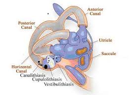 Bppv Benign Paroxysmal Positional Vertigo Vertigo Symptoms Elderly Crafts Traumatic Brain Injury