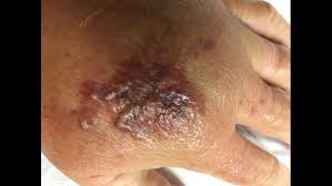 A Prick From A Shrimp Leads To Infection With Flesh Eating Bacteria Firstcoastnews Com
