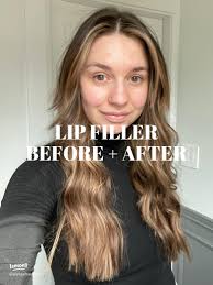 Transform Your Look: Touch Up Lip Filler and Chin Filler Experience