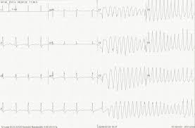 The atrial pacing rate increases after each atrial sensed event that is not classified as an atrial extrasystole. Torsades De Pointes Approach To Resuscitation First10em