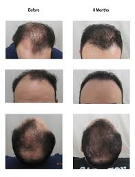 Before And After Of Recent Hair Transplant At 8 Months Hair Transplant Hair Restoration Hair