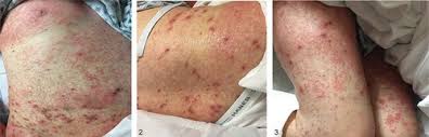 Image result for scabies norvegica