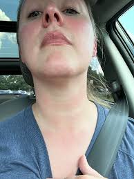 Can pine allergen cause a rash