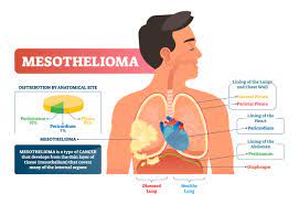 There are va benefits available for veterans diagnosed with malignant mesothelioma, including disability and va health care. What Test Shows Mesothelioma Pintas Mullins Law Firm