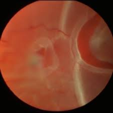 It's often accompanied by the sudden onset of symptoms such as floaters and flashing lights. Retinal Tears Retina Associates Of St Louis