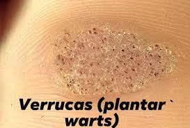 Image result for verrucae filiformes