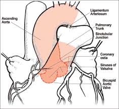 Tetralogy of fallot is the most common heart defect in children which ultimately leads to the child's blood not being tetralogy of fallot. Aortopathy Associated With Congenital Heart Disease A Current Literature Review Francois K Ann Pediatr Card