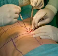 Mit gesunder ernährung, sport und kalorientabelle natürlich abnehmen und die lästigen pfunde verlieren! Nach Dem Abnehmen Fettschurze Lasst Sich Nicht Einfach Abstreifen Welt