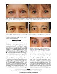 But my doctors cannot flip my upper eyelid inside out enough to remove those higher/inner stones. Original Article Orbicularis Suspension Flap And Its Pages 1 6 Flip Pdf Download Fliphtml5