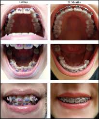 To Braces And Beyond Dental Braces Teeth Braces Brace Face
