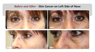It affects people of all races, genders and ages, which is why it's absolutely critical for americans to learn about. Eyelid Facial Skin Cancer Triad Eye Institute