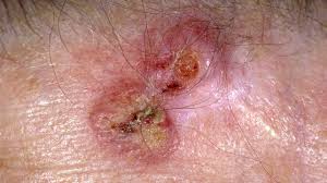 Symptoms of cherry angioma include: What Is A Cherry Angioma Causes Treatment And Removal