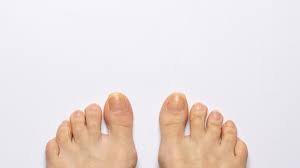 Image result for Yellow nail syndrome feet