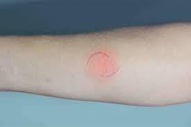 Image result for Human Bite