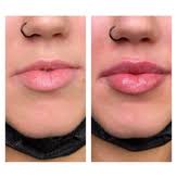 Lip Filler