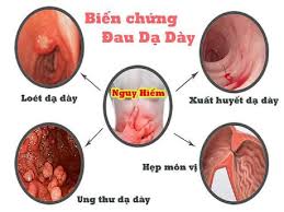聖揀), là một nhân vật trong truyền thuyết việt nam, một trong bốn vị thánh mà người việt gọi là tứ bất tử trong tín ngưỡng dân gian việt nam. Ä'au Dáº¡ Day La Ä'au á»Ÿ Ä'au Co Triá»‡u Chá»©ng Tháº¿ Nao Xá»­ Ly Ra Sao Medlatec