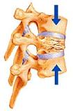 Image result for icd-10 code for non traumatic t12 compression fracture
