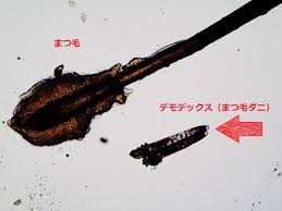 デモ デックス 治療