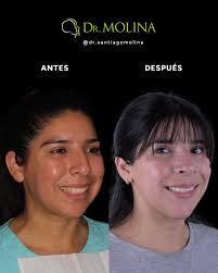 Cirugía Ortognática Mínimamente Invasiva⁣⁣⁣⁣ ⁣⁣⁣ 👩🏻‍⚕️⁣ Ortodoncia a  cargo de Dra. Laura Andrada (@dralauraandrada)⁣⁣ ⁣⁣⁣ 🔎 La deformidad  dentofacial que sufría el paciente fue corregida exitosamente mediante una  cirugía ortognática mínimamente ...