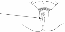 Ingrown hair occurs when the tip of the hair grows back and either touches the skin or grows right back into the skin. Sores On The Genitals Genital Ulcers Hesperian Health Guides