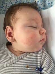 Babys Haut Picke Flecken Stellen Juli 2016 Babyclub Babycenter
