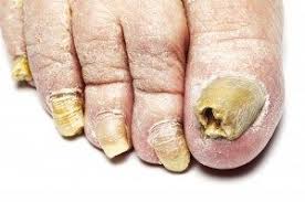 cure ugly toenails