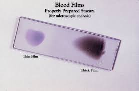 Gli elementi visibili e la natura dell'immagine risultante dipenderanno in gran parte una microscopia di striscio di sangue è uno studio che viene eseguito al microscopio. Striscio Su Vetrino Wikipedia
