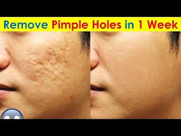 Getting rid of acne scars effectively. Pin On Masks