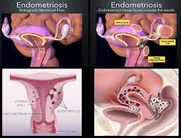 Endometriosis is more common in women who are having fertility issues, but it does not necessarily cause infertility. Painful Periods Endometriosis Adenomyosis Anthony Siow