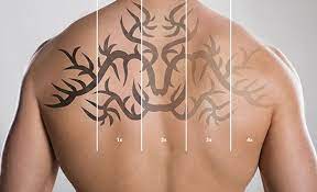 The biggest problem that a person has to face when he is planning to get a laser tattoo removal done in toronto is the cost of the procedure. 1 Rated Laser Tattoo Removal Toronto Easily Remove Unwanted Tattoos Black Line Studio Black Line Studios
