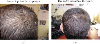 There are quite some hair loss treatment options available. Figure 2 From Pilot Study Of 15 Patients Receiving A New Treatment Regimen For Androgenic Alopecia The Effects Of Atopy On Aga Semantic Scholar