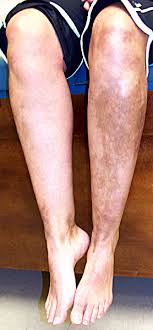 Inflammatory & Immune Myopathies - Myositis | Homeopathic | Best Myositis | Homeopathic Doctor in Pakistan | Dr Qaisar Ahmed MD, DHMS