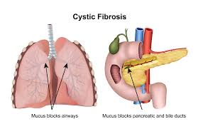 Early antibiotic treatment for pseudomonas aeruginosa eradication in patients with cystic fibrosis: Pediatric Cystic Fibrosis Ohsu