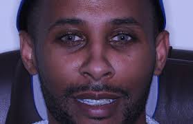 ColorEyes™ Keratopigmentation Los Angeles & Beverly Hills CA