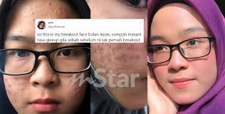 Jerawat adalah penyakit kulit yang bisa menyerang para wanita maupun pria. Muka Jerawat Teruk Selepas Mandi Kolam Pakwe Terus Minta Putus Tapi Tak Sampai 2 Bulan Kulit Gadis Ini Alami Transformasi Wow Viral Mstar